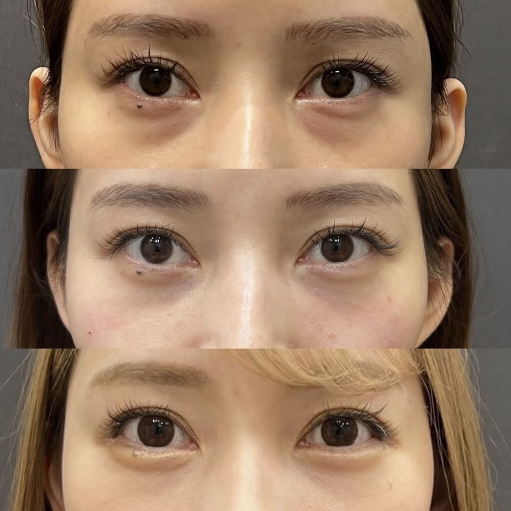 真ん中の症例は裏ハムラの症例、下の症例は目尻靭帯移動術と涙袋のヒアルロン酸