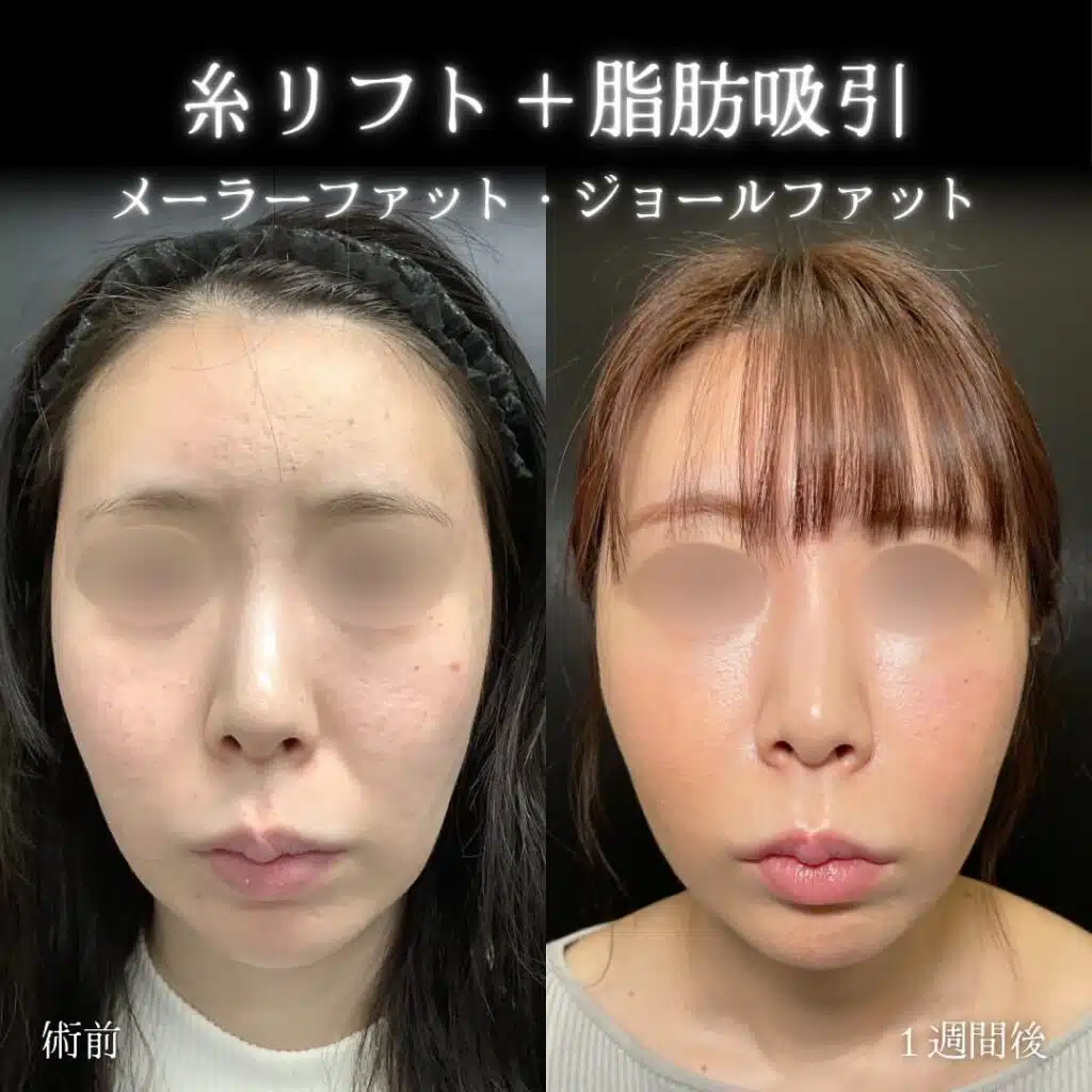 糸リフト+脂肪吸引 名古屋