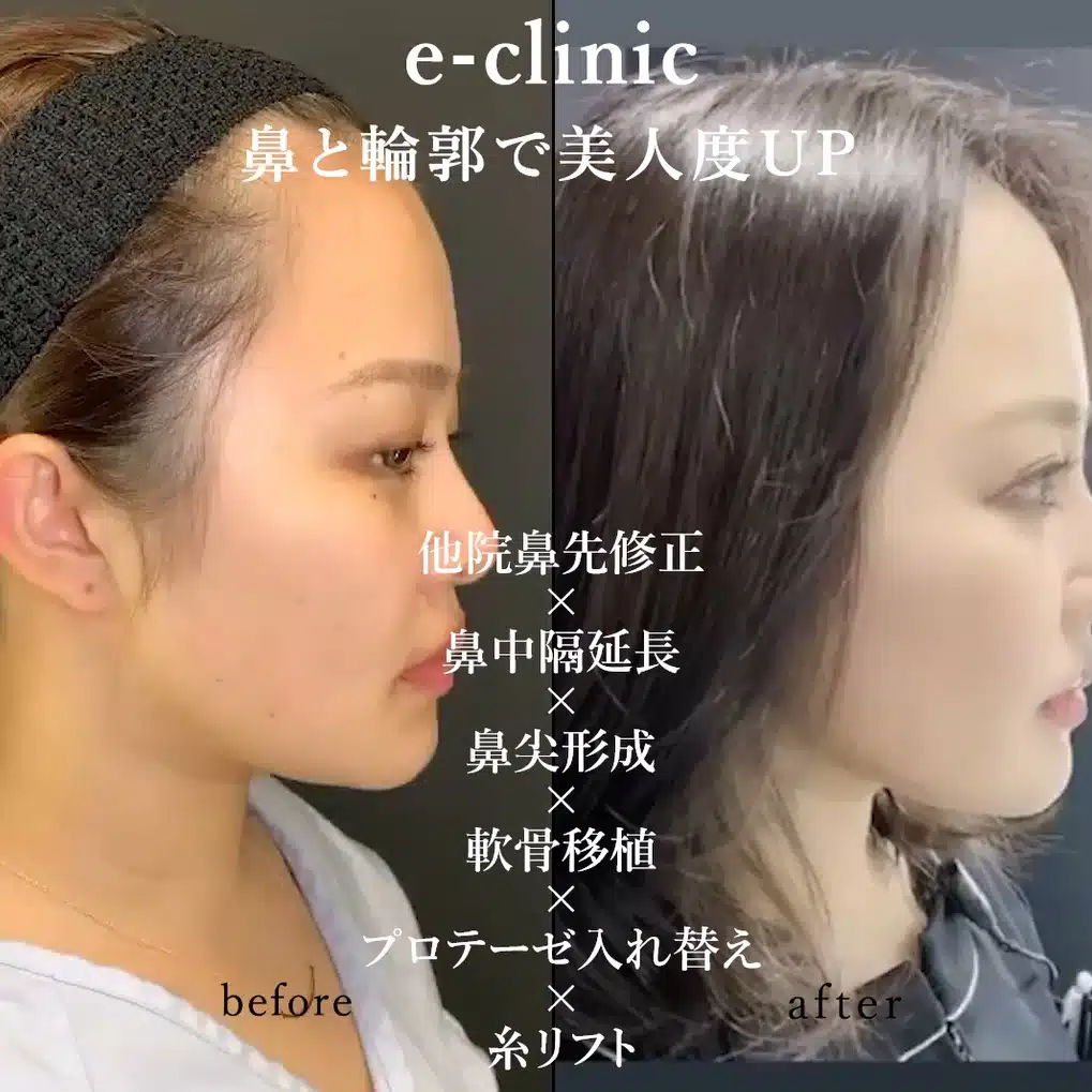 他院鼻先修正×鼻中隔延長×鼻尖形成×軟骨移植×プロテーゼ入れ替え×糸リフト 名古屋