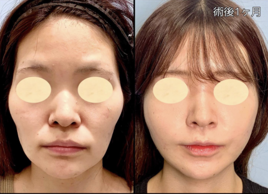 小顔脂肪吸引③