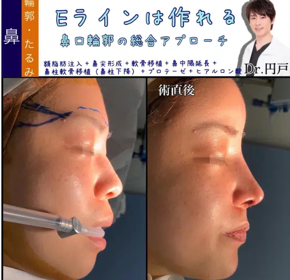 額脂肪注入+鼻尖形成+軟骨移植+鼻中隔延長+鼻柱軟骨移植（鼻柱下降）+プロテーゼ+ヒアルロン酸　名古屋