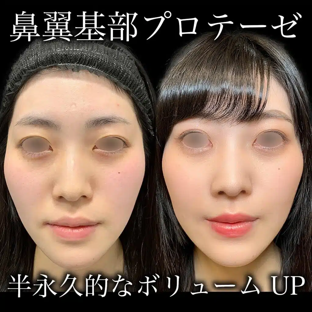 鼻翼基部プロテーゼ　名古屋