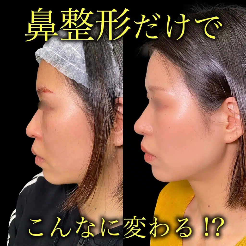 鼻尖形成と耳介軟骨移植と小鼻縮小 名古屋