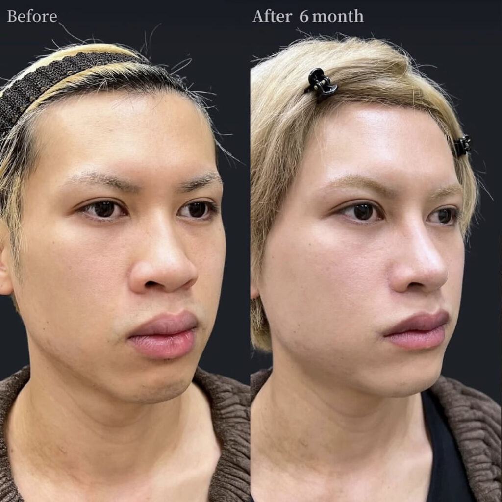 男性の鼻フルと小鼻縮小とリップリフトと口唇縮小と口角挙上の症例写真