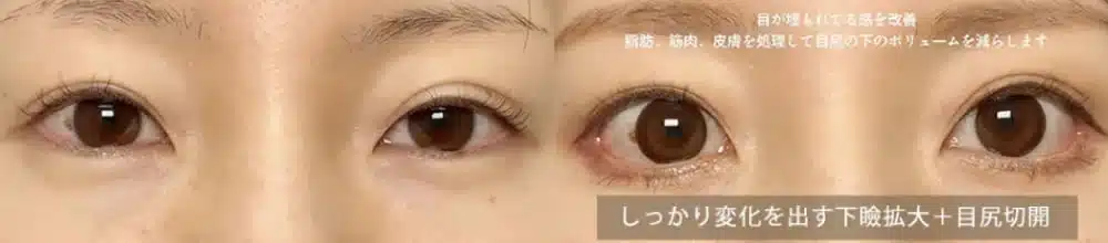 しっかり変化を出す下瞼拡大＋目尻切開　名古屋