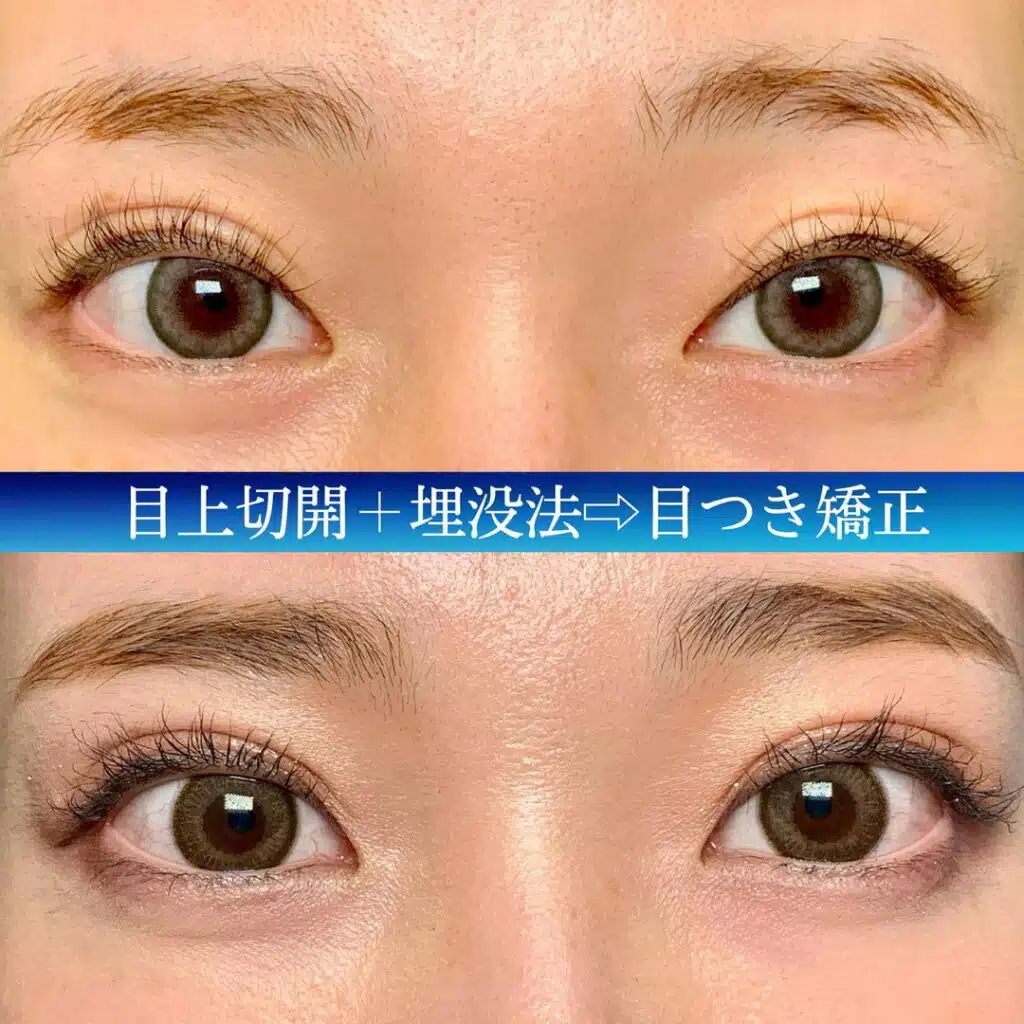 目上切開+埋没法　名古屋