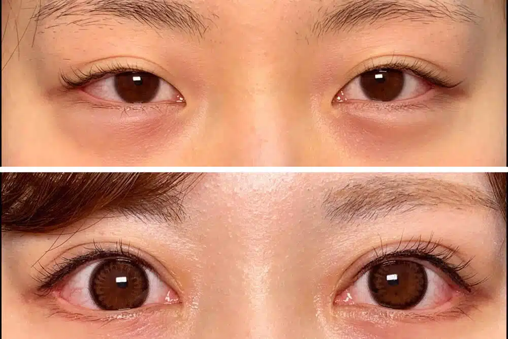 目尻切開+目頭切開 名古屋
