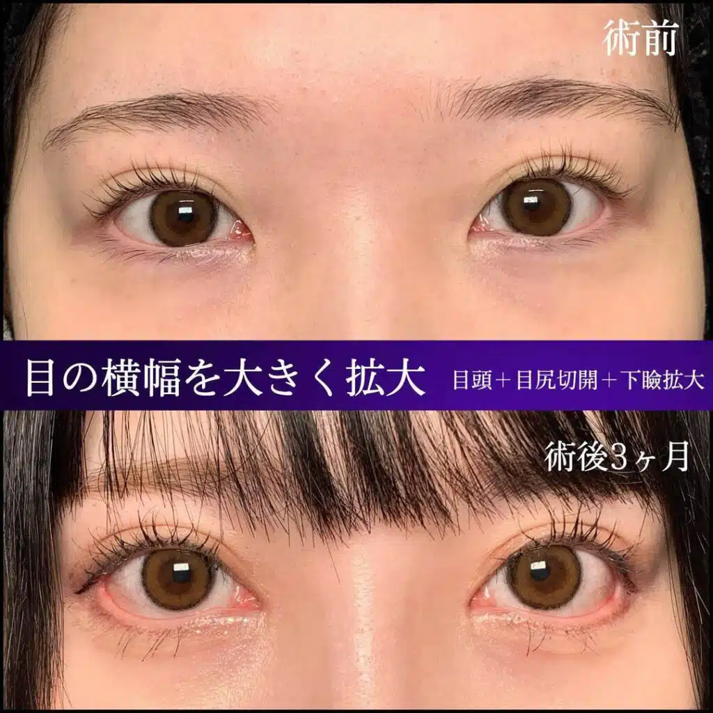 目頭+目尻切開+下瞼拡大 名古屋