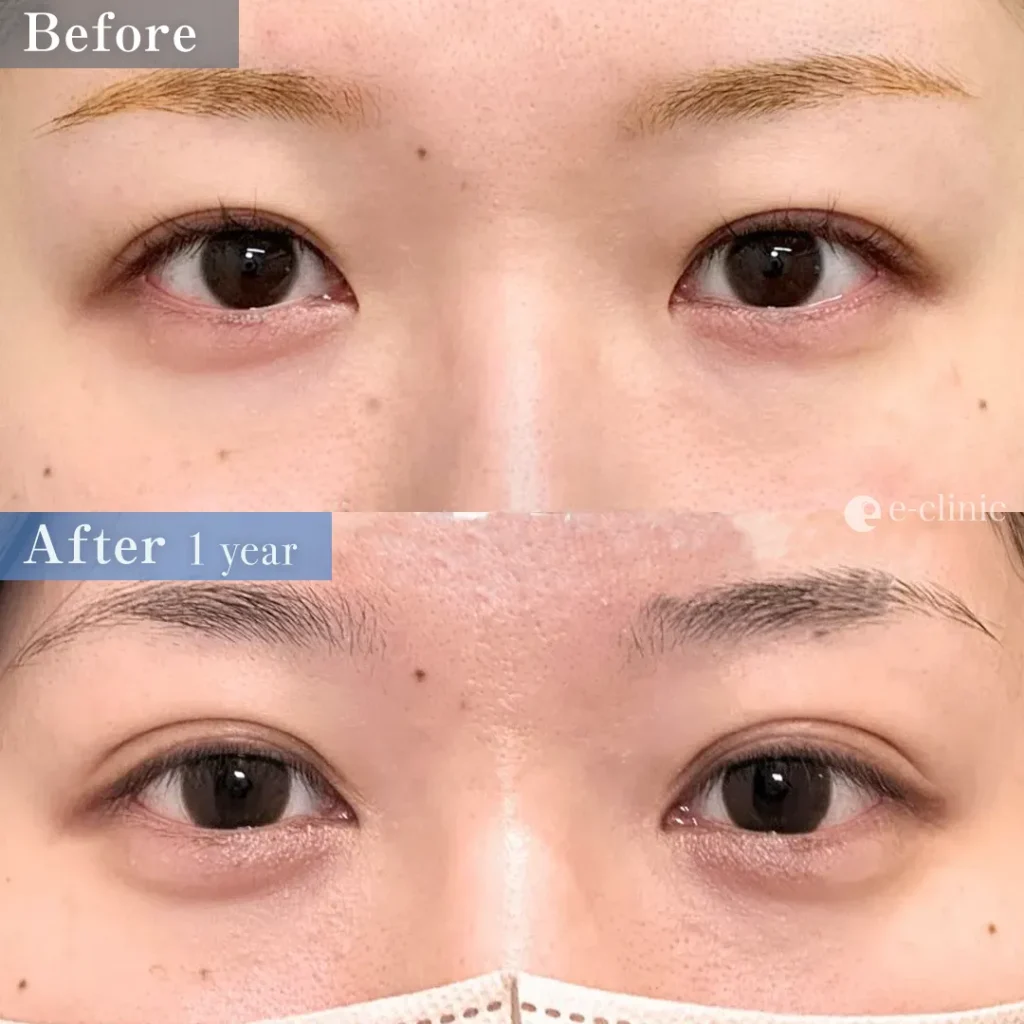 eクリニック名古屋院の二重整形・二重埋没法の症例写真