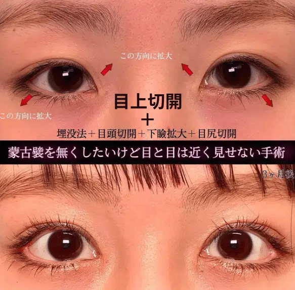 目上切開+埋没法+目頭切開+下瞼拡大+目尻切開　名古屋