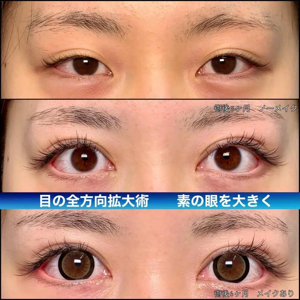 目の全方向拡大術　名古屋