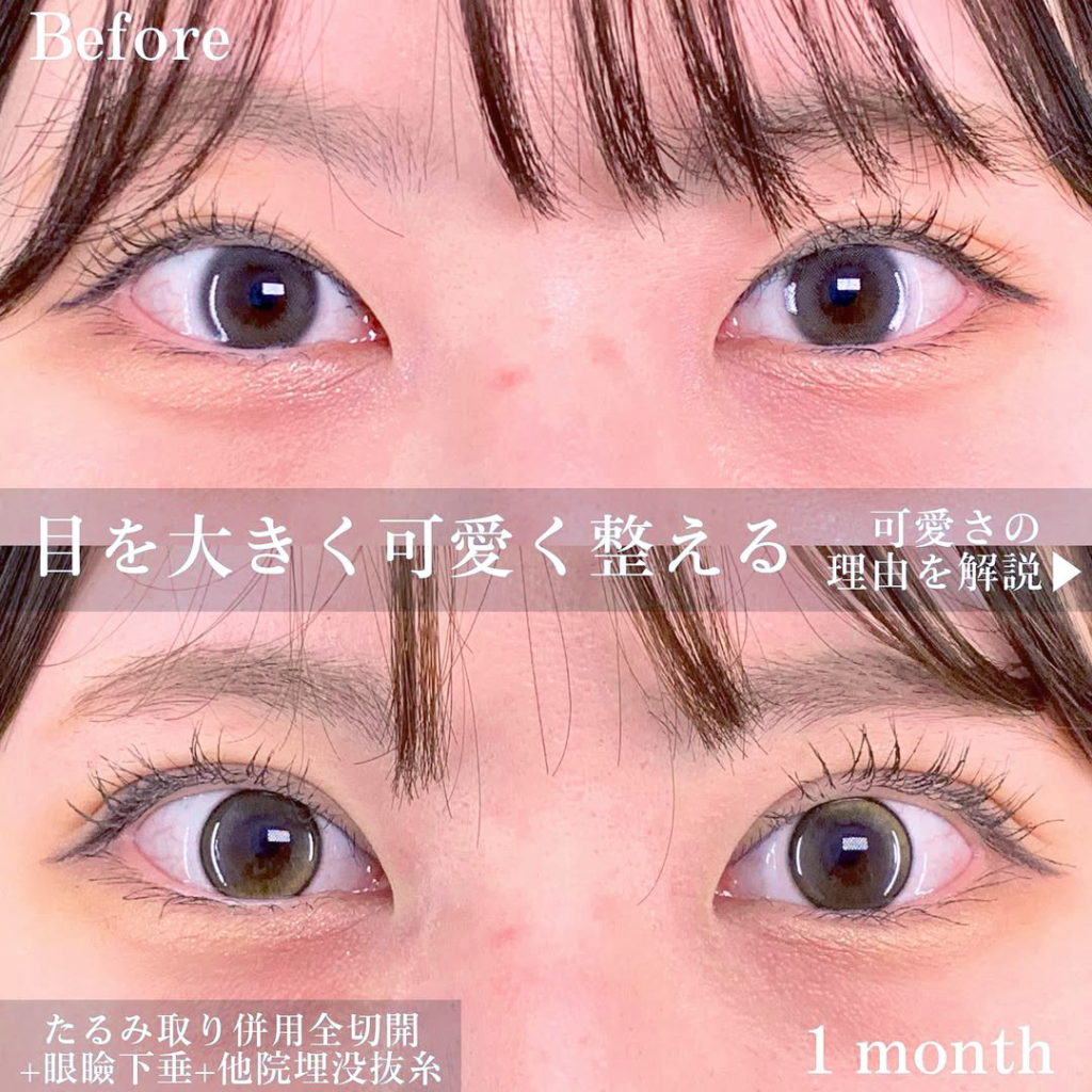 埋没法②