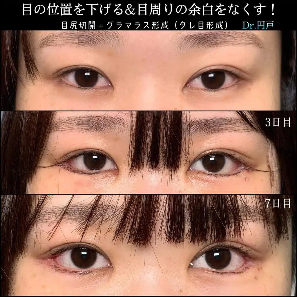 目尻切開＋グラマラス形成（タレ目形成）　名古屋