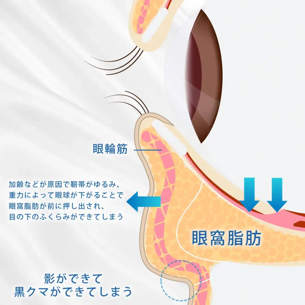 クマ・目の下のたるみの原因になる眼窩脂肪の突出についての図解