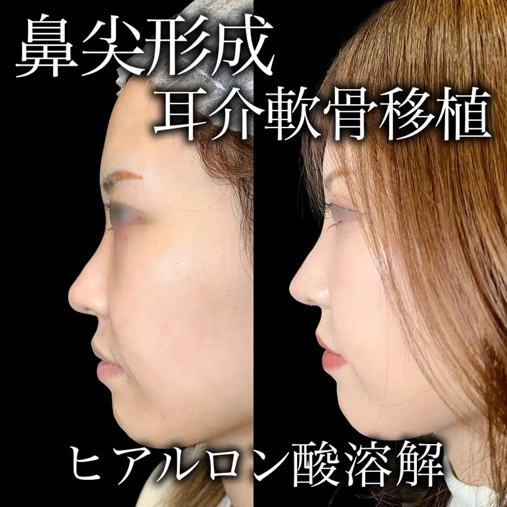 鼻尖形成と耳介軟骨移植 名古屋