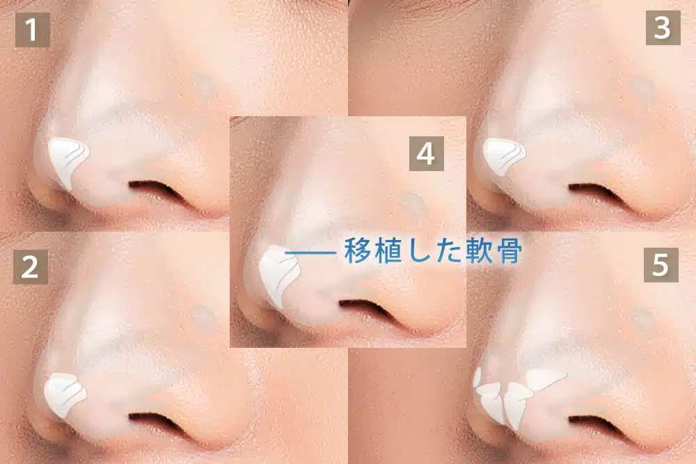 鼻尖軟骨移植の5つのパターン 名古屋