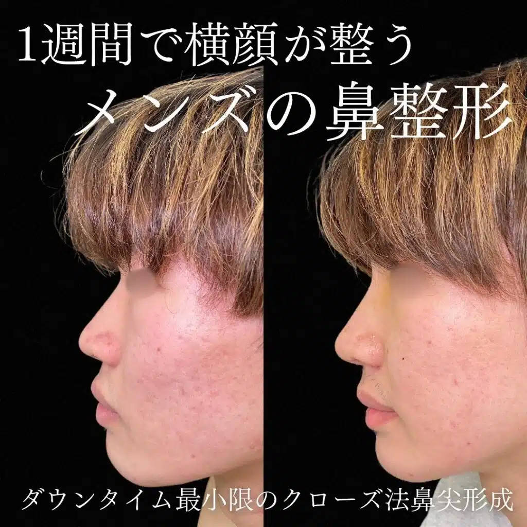 クローズ法鼻尖形成　名古屋