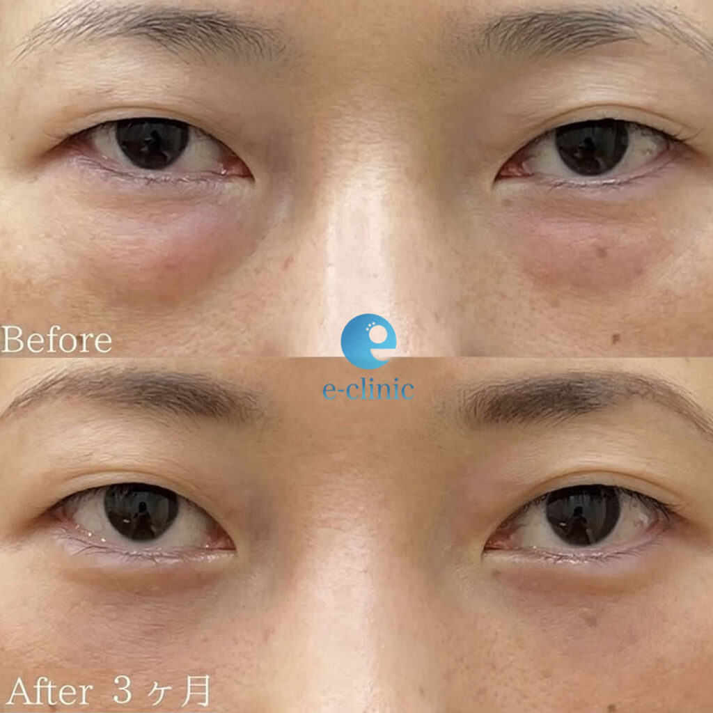 裏ハムラ法の症例写真 (1)