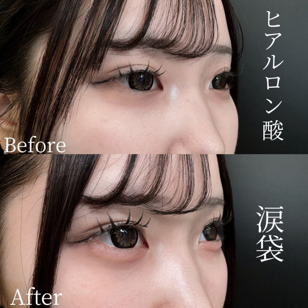 ヒアルロン酸　涙袋