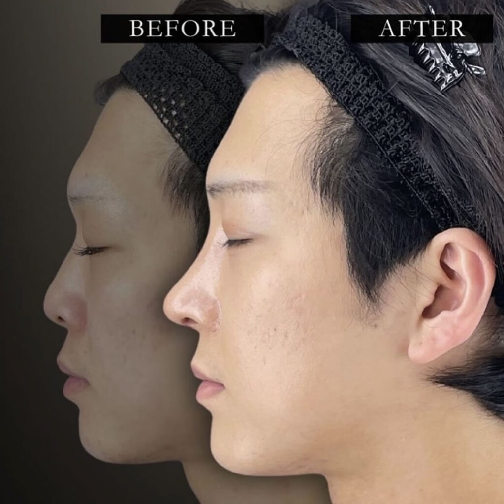 メンズの鼻フルの症例写真1