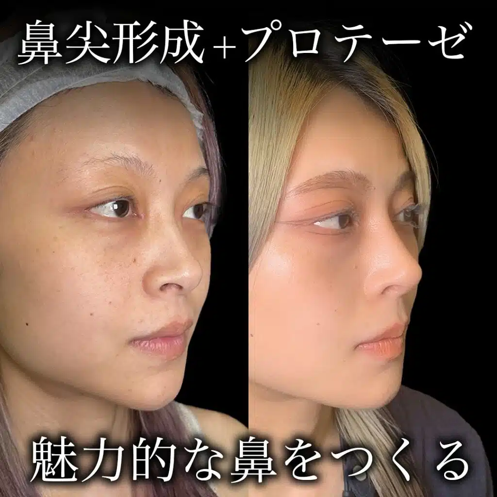 鼻尖形成+プロテーゼ　名古屋