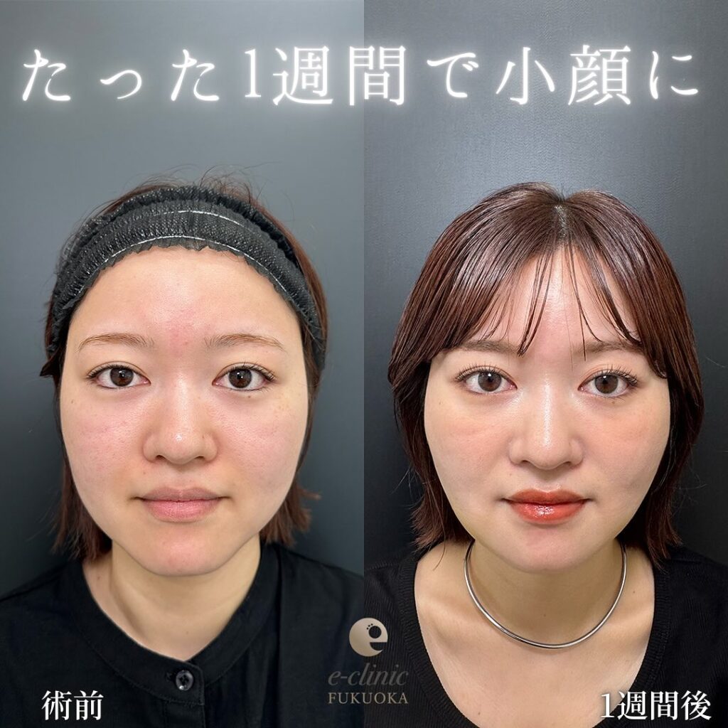 糸リフト①