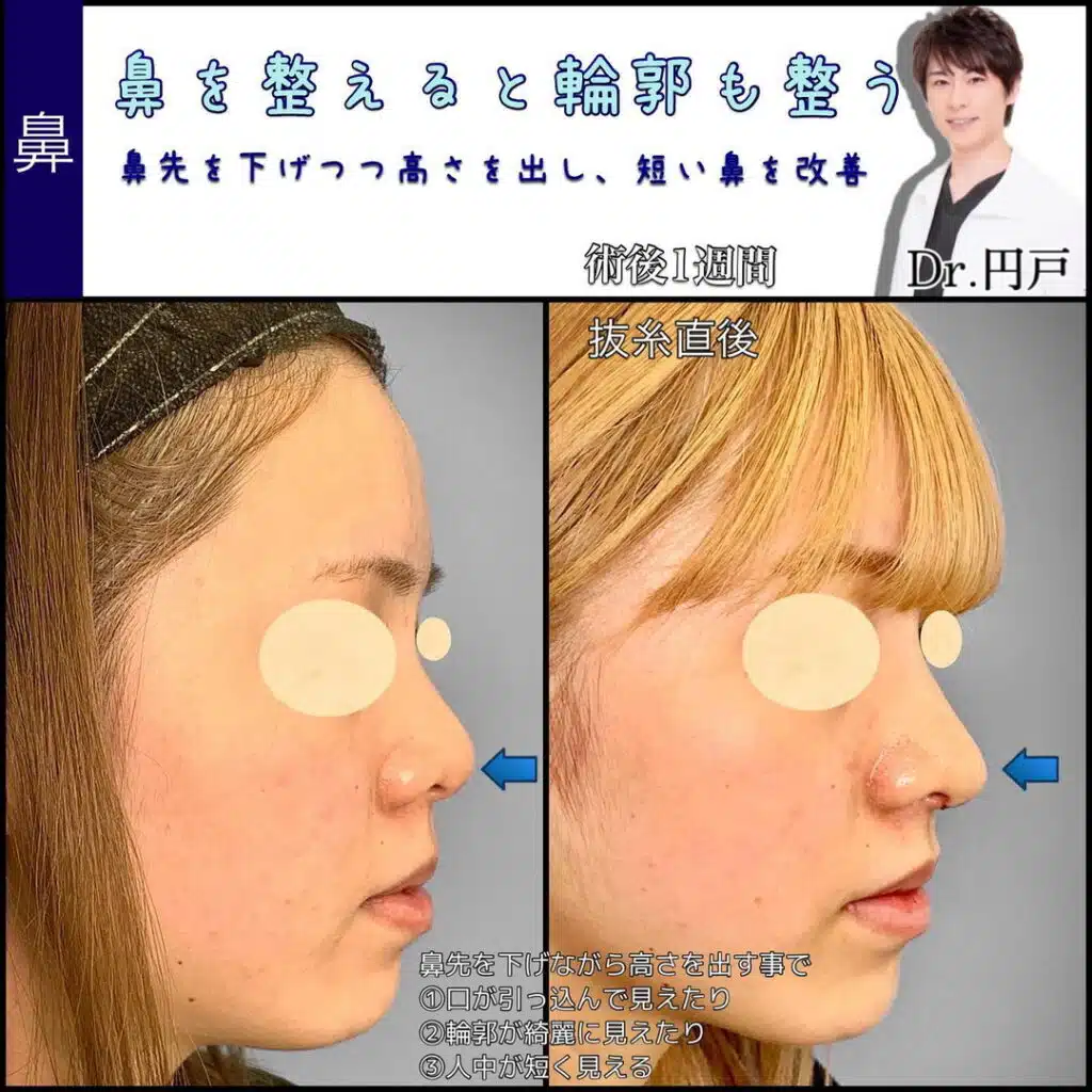 鼻尖形成と鼻中隔延長と軟骨移植 名古屋