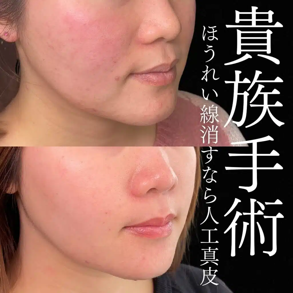 貴族手術　名古屋