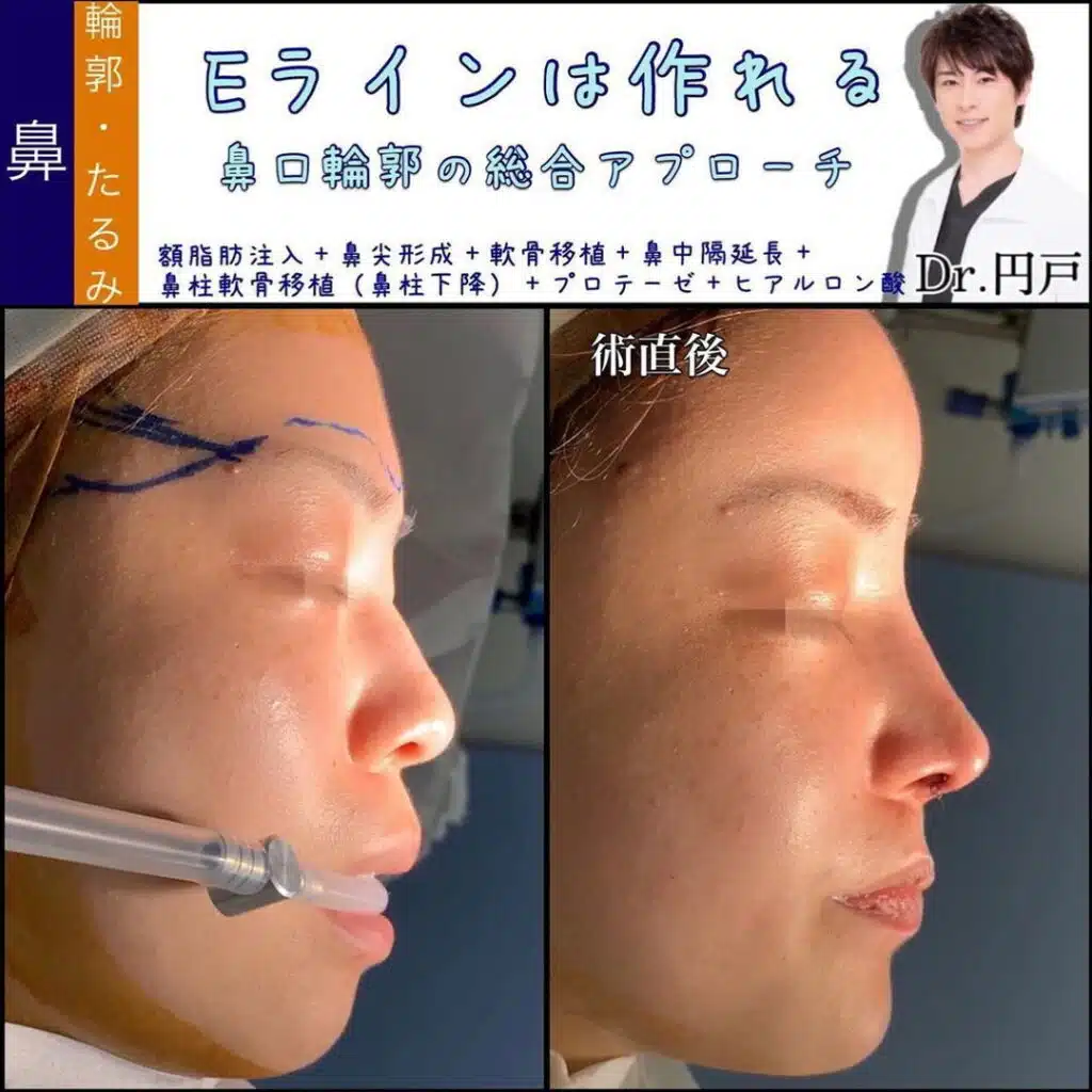 額脂肪注入+鼻尖形成+軟骨移植+鼻柱軟骨移植(鼻柱下降)+プロテーゼ+ヒアルロン酸 名古屋