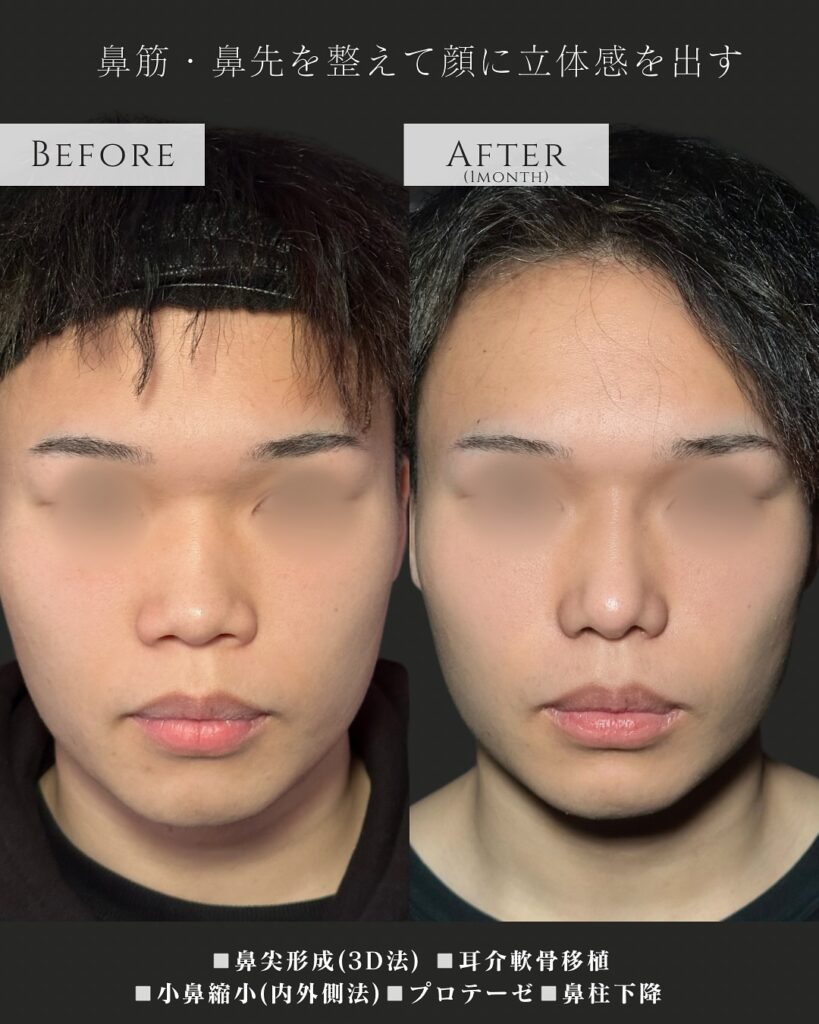 鼻尖形成と耳介軟骨移植と小鼻縮小とプロテーゼと鼻柱下降の症例写真