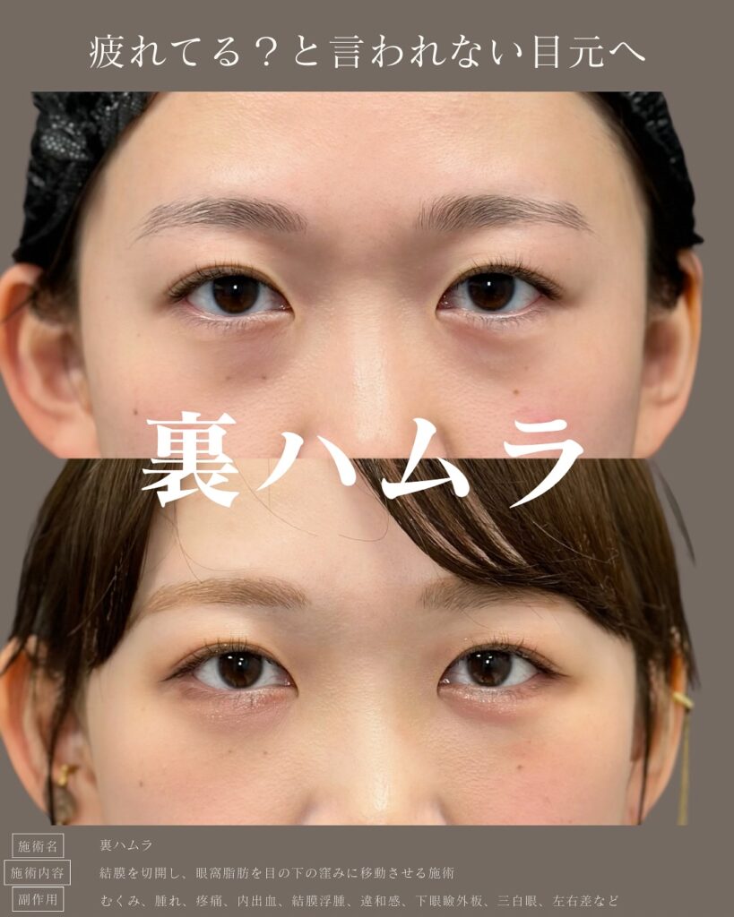 裏ハムラ法の症例写真