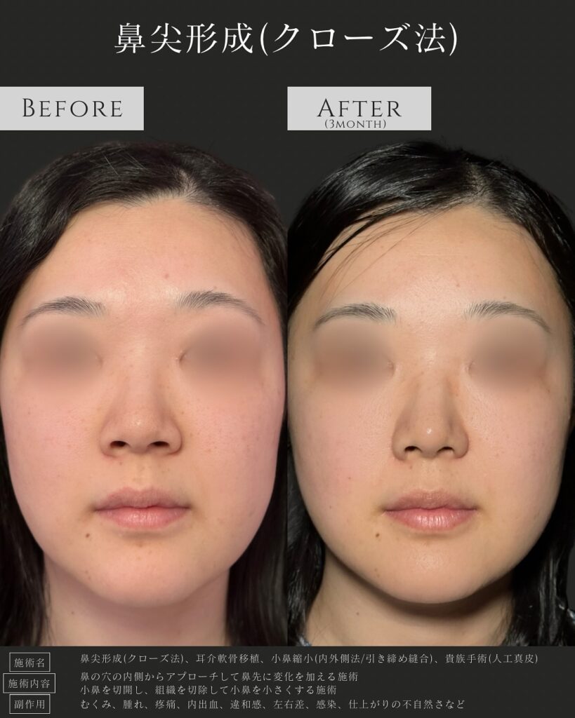 鼻尖形成の症例写真