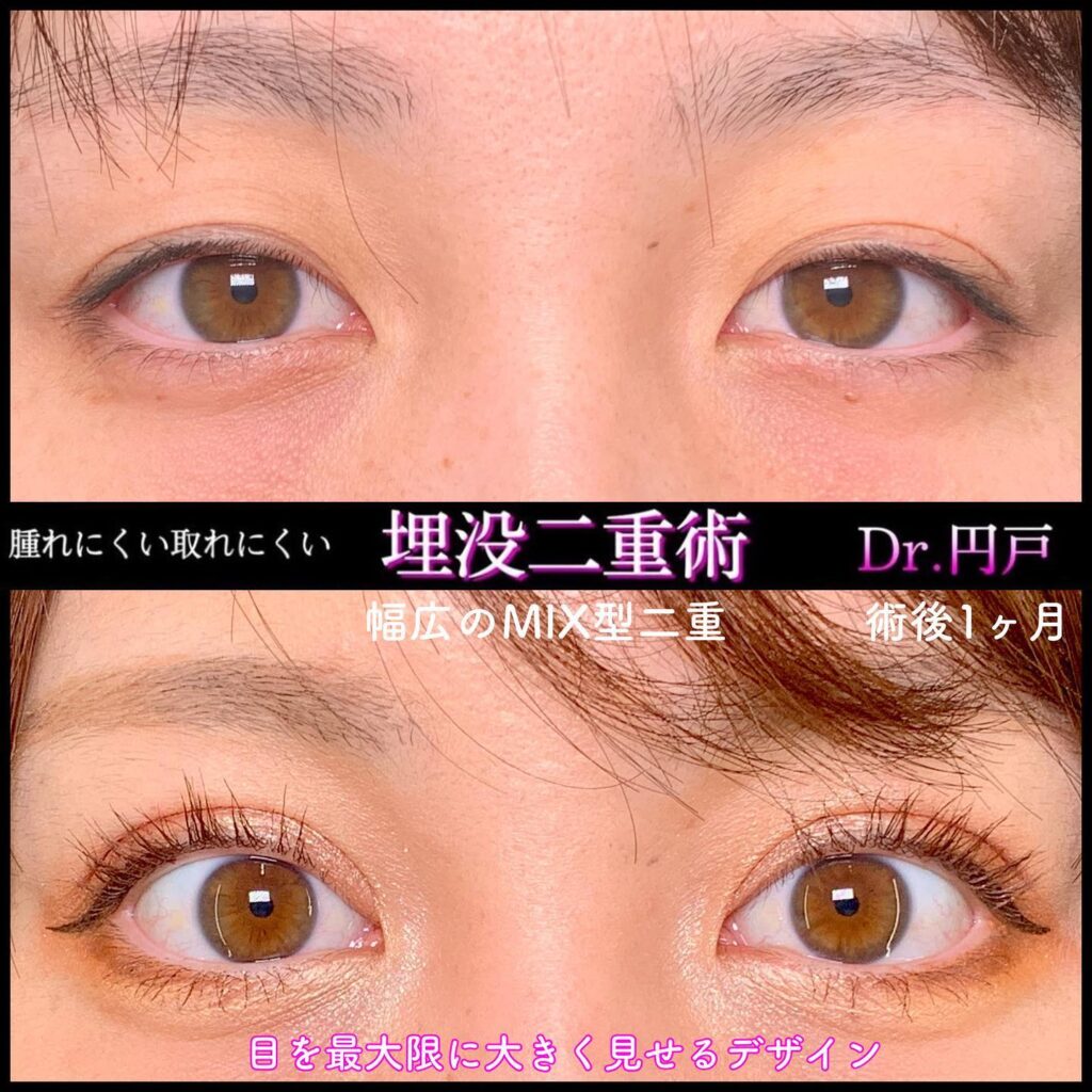 埋没法の症例写真