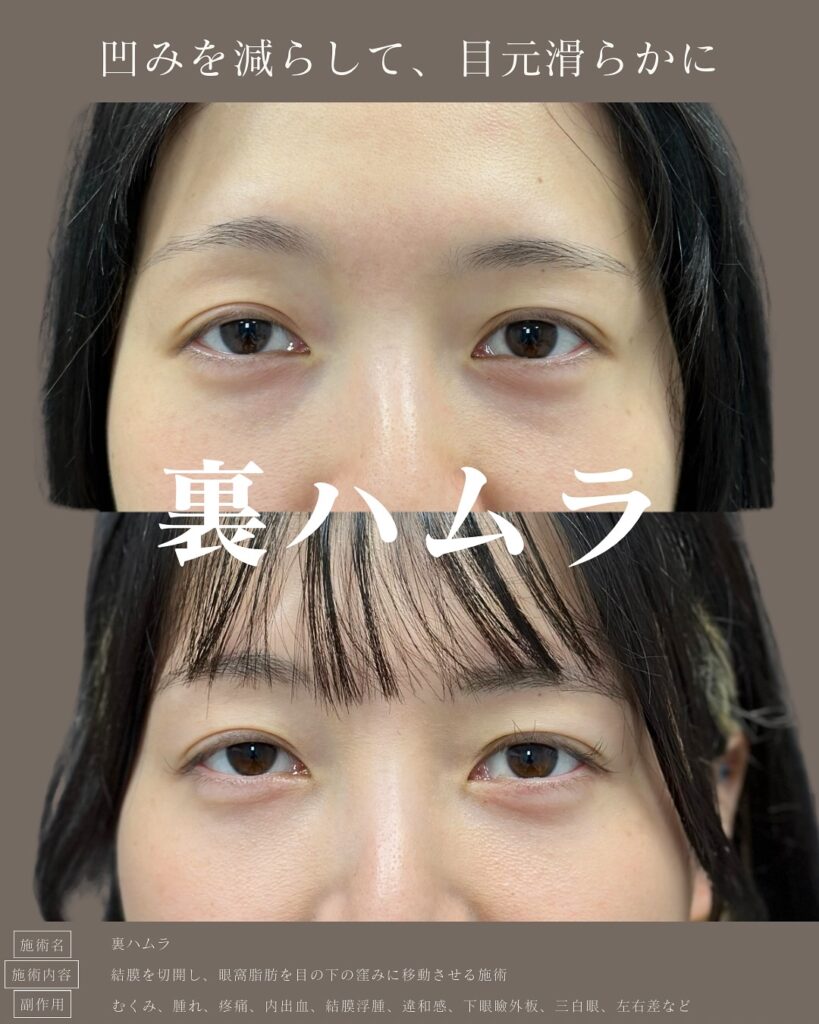裏ハムラ法の症例写真