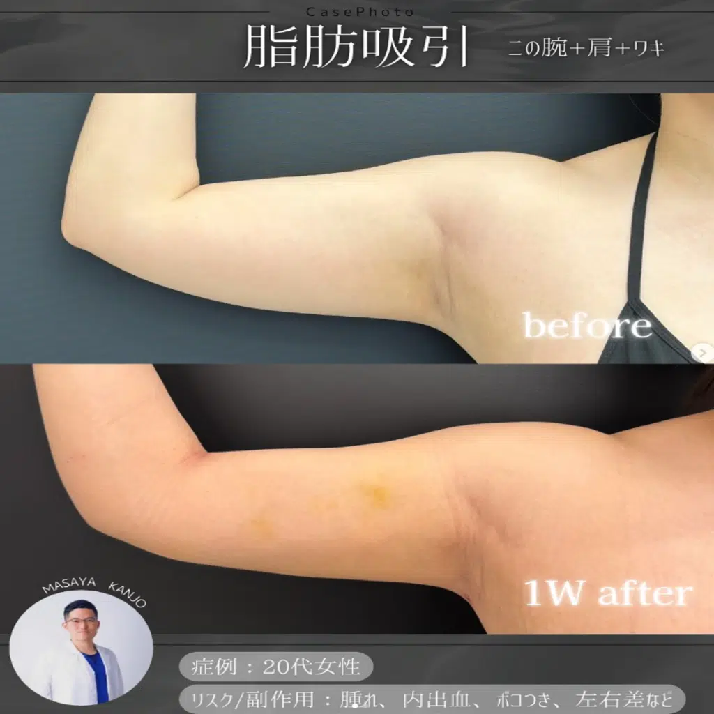 脂肪吸引　二の腕+肩+ワキ　名古屋