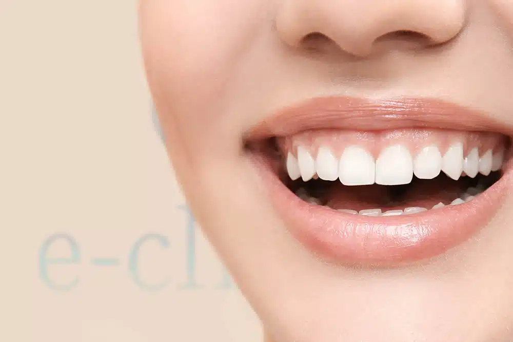 ガミースマイルボトックス　名古屋