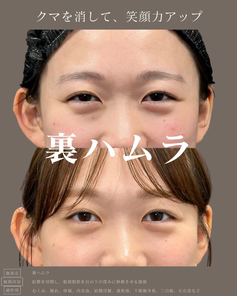 裏ハムラ法の症例写真