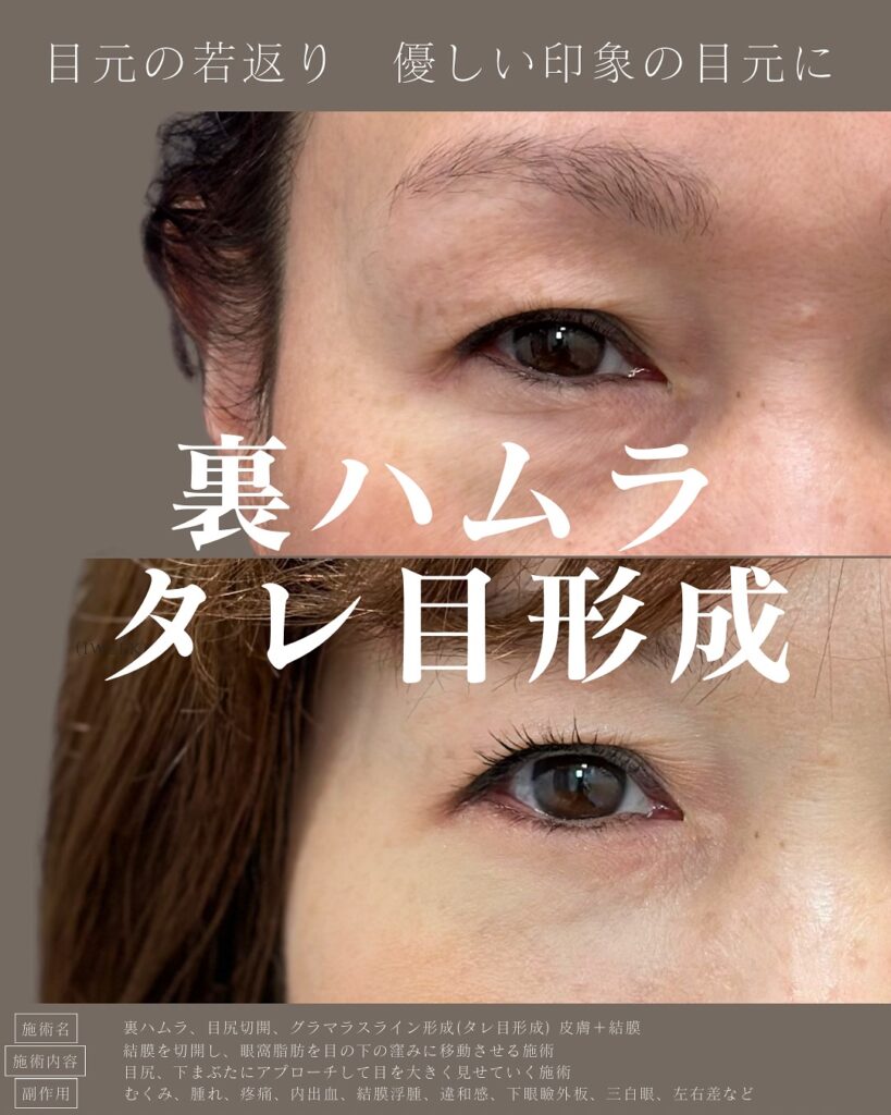 裏ハムラ法とタレ目形成の症例写真
