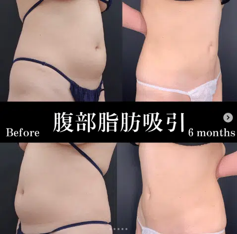 腹部脂肪吸引　名古屋