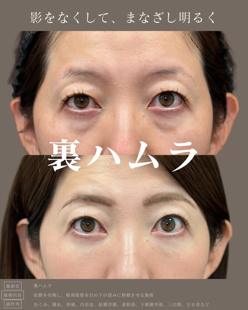 裏ハムラ法の症例写真