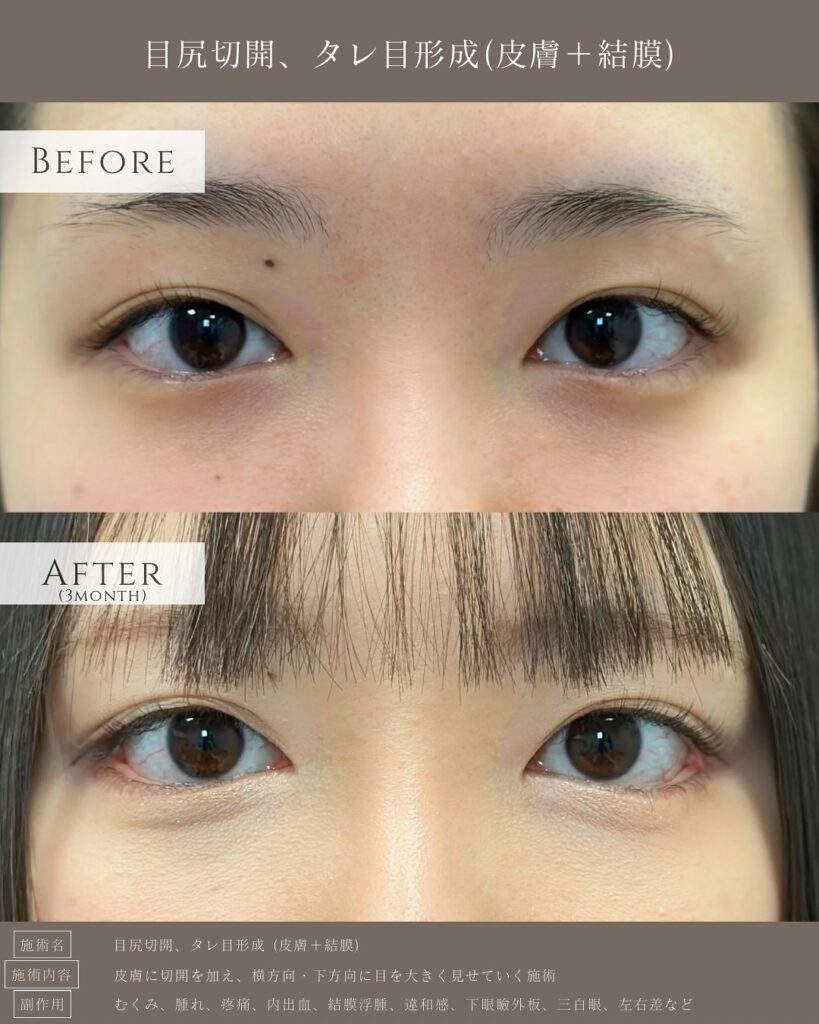 目尻切開の症例写真 (3)