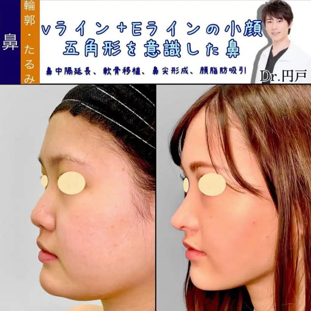 鼻中隔延長、軟骨移植、鼻尖形成、顔脂肪吸引　名古屋