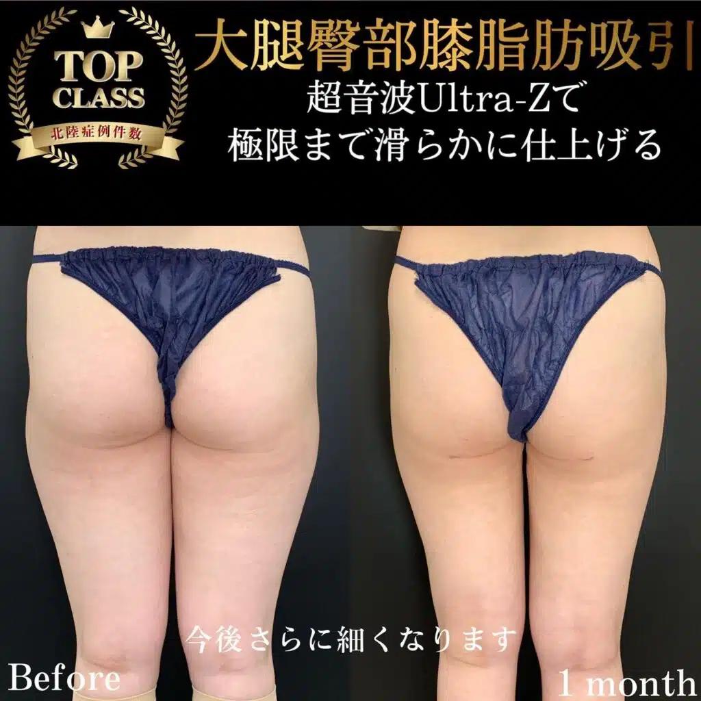 大腿臀部膝脂肪吸引　名古屋