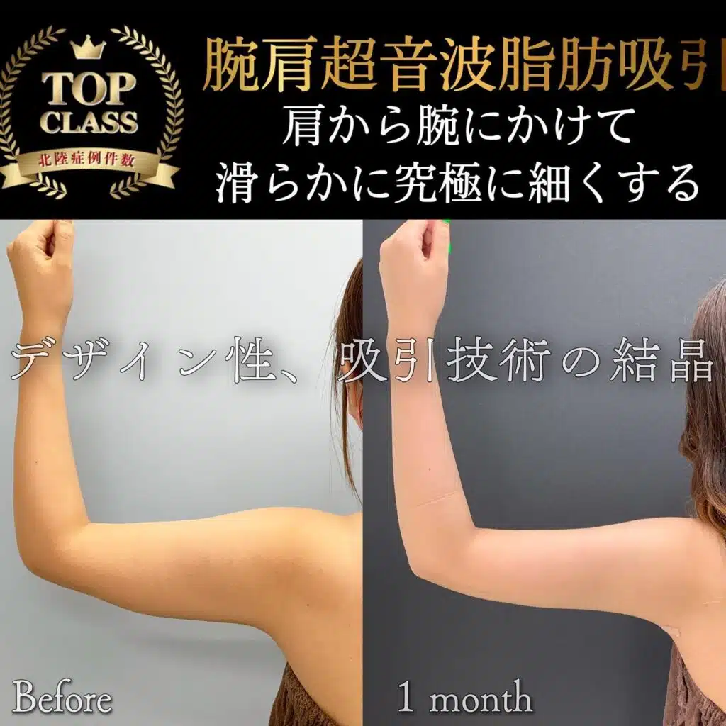 腕肩超音波脂肪吸引　名古屋