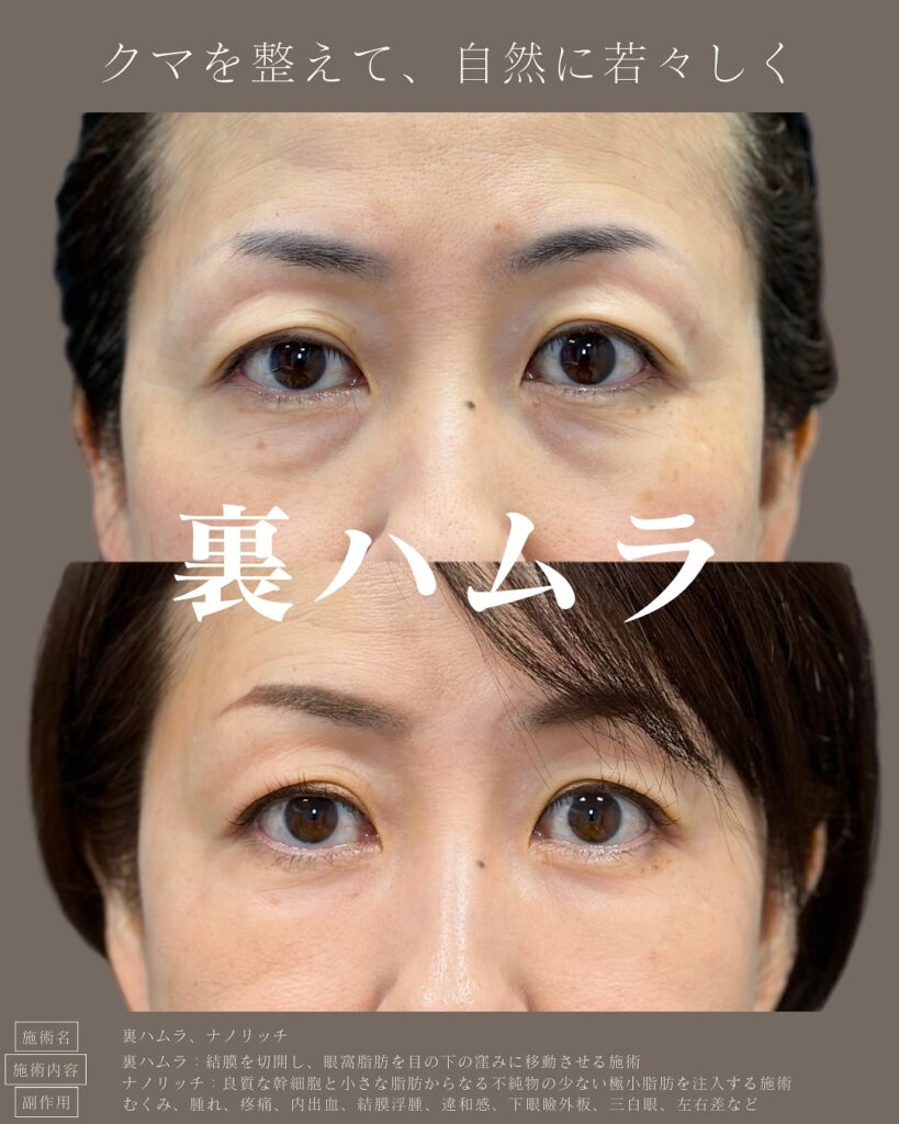 裏ハムラ法の症例写真