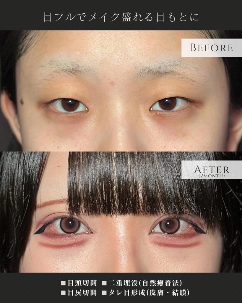 目頭切開と目尻切開と埋没法とタレ目形成の症例写真
