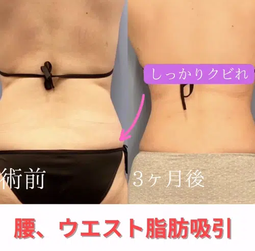 腰、ウエスト脂肪吸引　名古屋