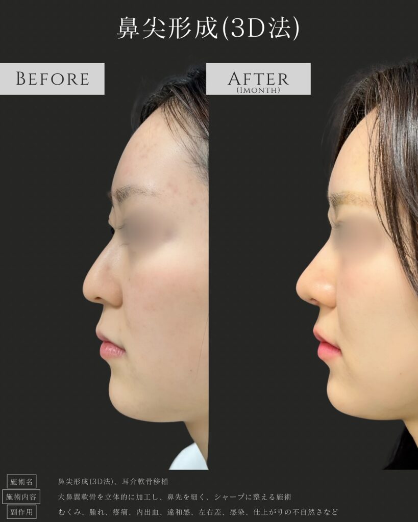 鼻尖形成3D法の症例写真 (3)