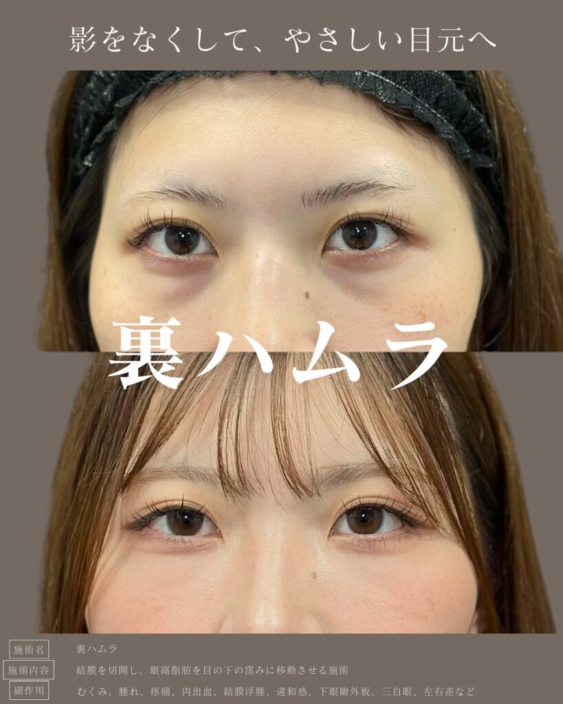 裏ハムラ法の症例写真