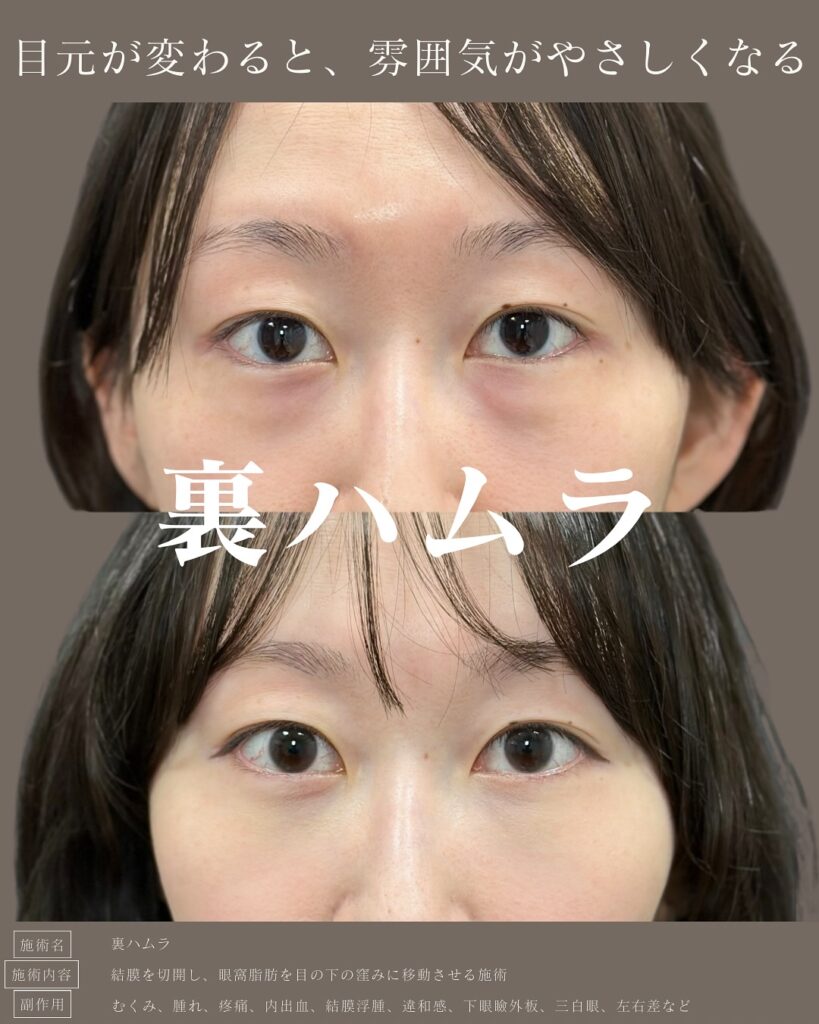 裏ハムラ法の症例写真